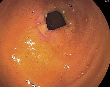 NSAID-related diaphragm in the distal ileum