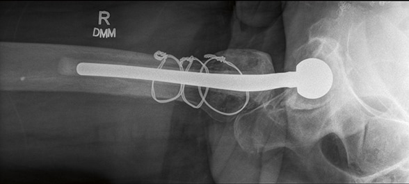 Lateral radiograph showing articulating antibiotic spacer