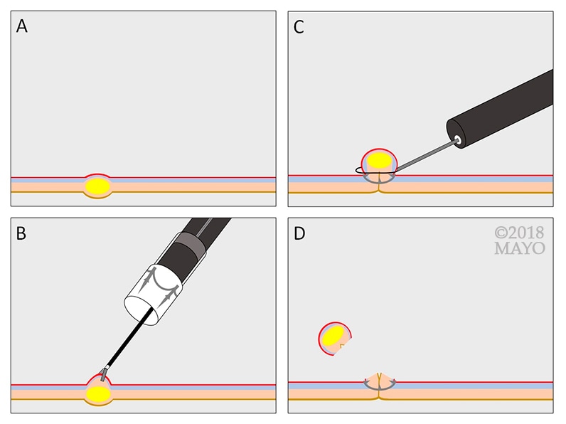 Clip-assisted endoscopic full-thickness resection of a subepithelial lesion