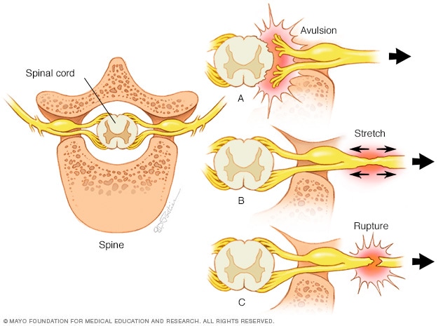 What are three 3 forms of nerve damage?