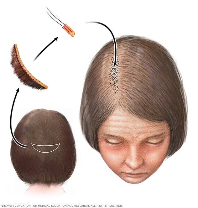 Mejorar patio hierro Caída del cabello - Diagnóstico y tratamiento - Mayo Clinic