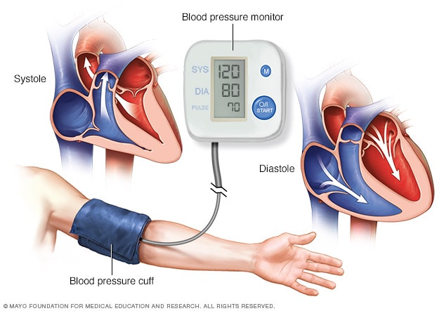High blood pressure (hypertension 