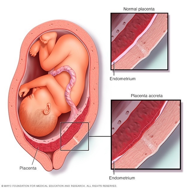 Placenta Accreta Symptoms And Causes Mayo Clinic