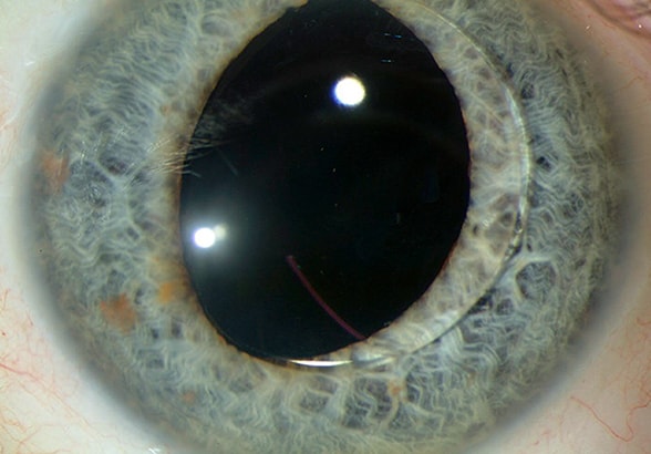 Caso de disinserción espontánea del háptico de la lente que conduce a la dislocación de la lente