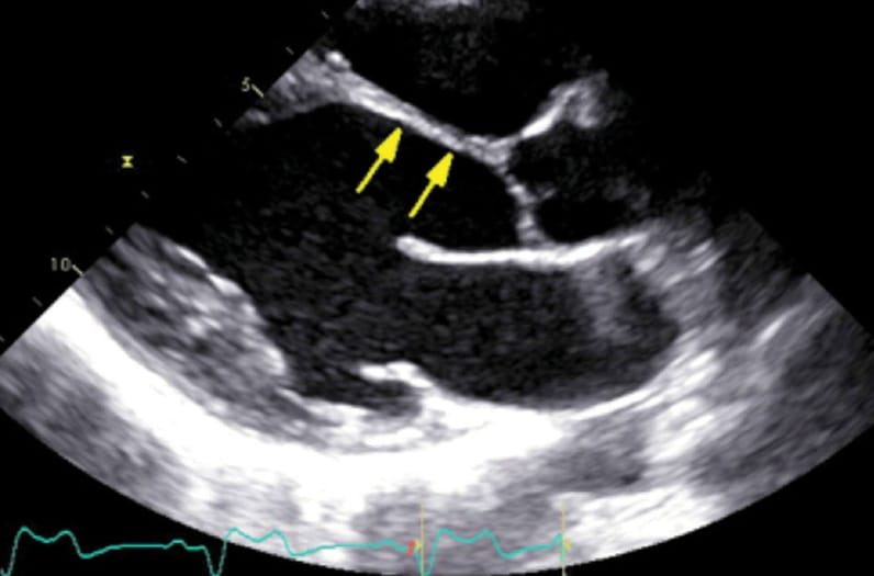 Transthoracic echocardiography imaging of patient with cardiac sarcoidosis