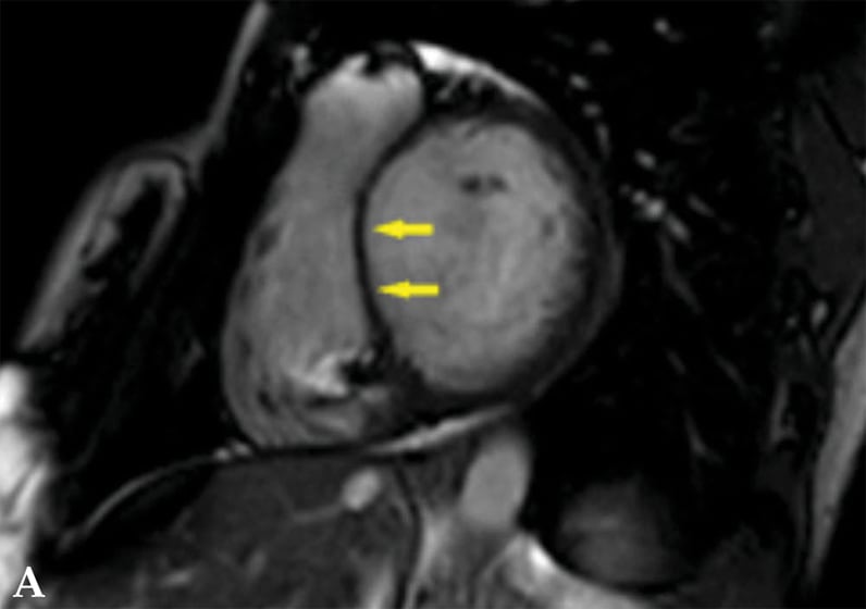 Imágenes por resonancia magnética cardíaca sin contraste de paciente con sarcoidosis cardíaca