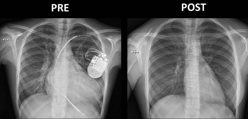 Chest radiographs before and after heart transplantation