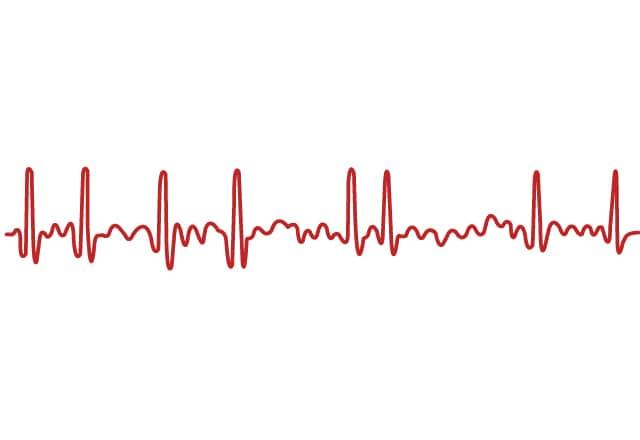 Atrial Fibrillation - Care At Mayo Clinic - Mayo Clinic