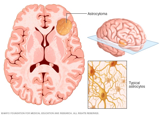 Astrocytoma Overview Mayo Clinic