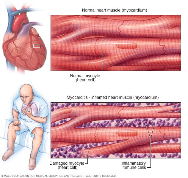 Inflammation of the heart muscle