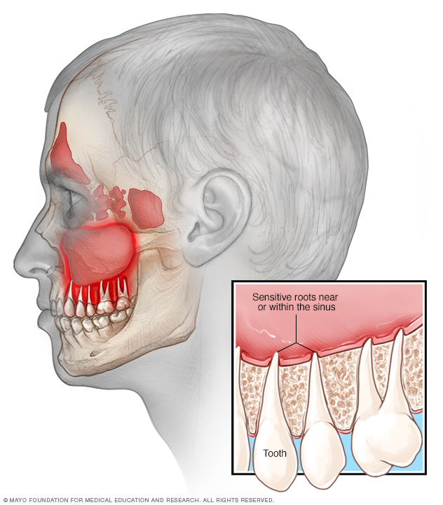 Can Sinus Cause Tooth Pain In Lower Teeth TeethWalls