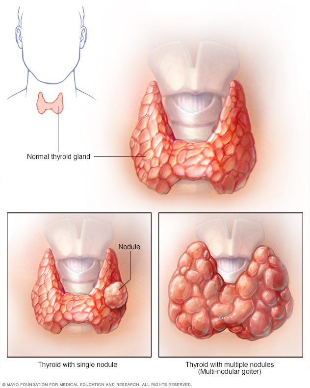 Thyroid Nodules Symptoms And Causes Mayo Clinic