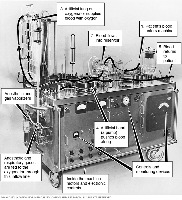 La primera máquina de baipás de corazón-pulmón del mundo