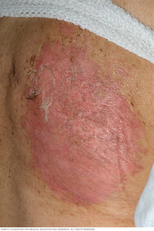 一位女性背部的 TEN 皮疹导致皮肤松弛、脱皮。