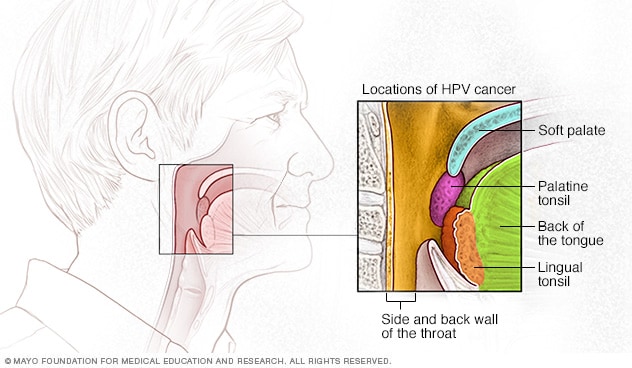 El VPH aumenta el riesgo de cáncer de garganta, paladar blando, amígdalas y la parte posterior de la lengua.