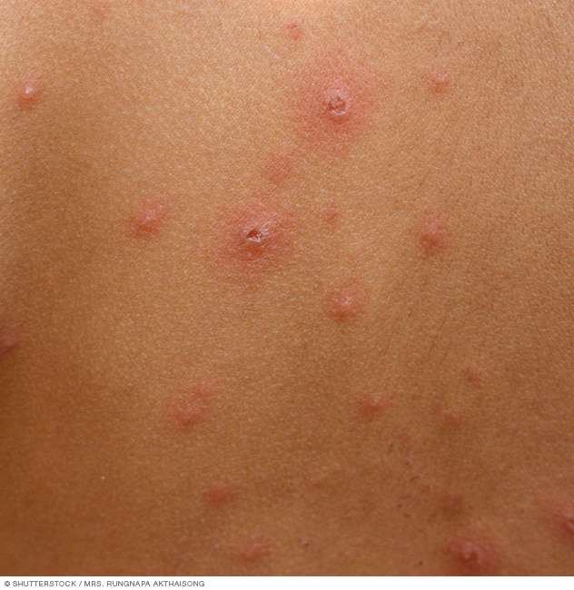 Chickenpox Symptoms And Causes Mayo Clinic