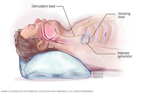 El estudio para diagnosticar apnea del sueño generalmente se puede hacer en  casa - Red de noticias de Mayo Clinic