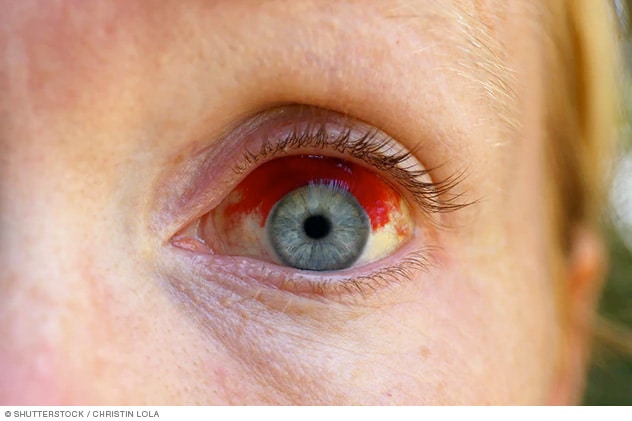 blood vessel burst in eye