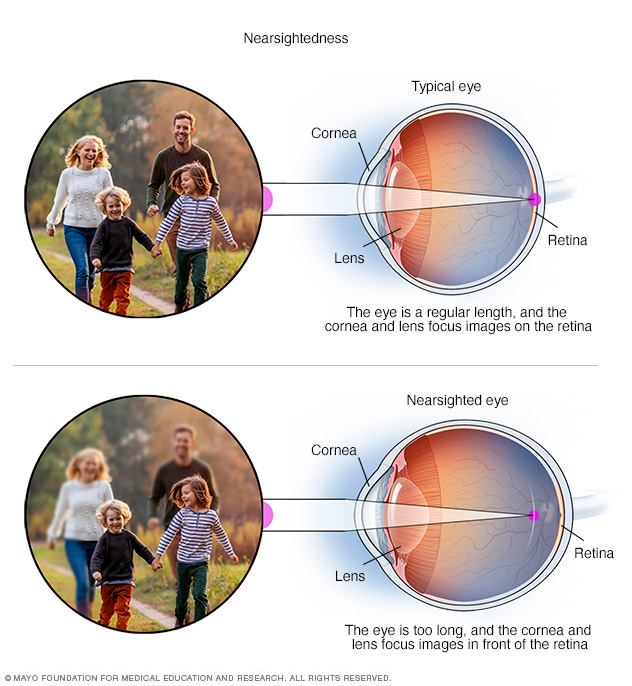 Nearsightedness Symptoms And Causes Mayo Clinic