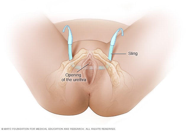 Surgery for stress urinary incontinence in women - Mayo Clinic