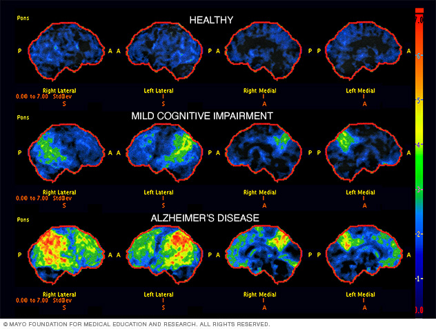 How Can Research Improve Lives?  Massachusetts Alzheimer's Disease  Research Center