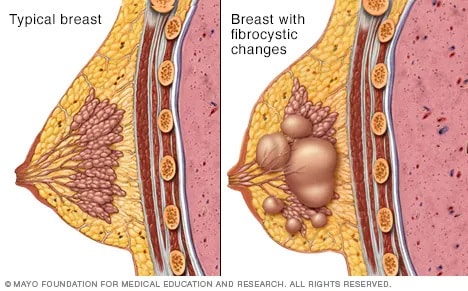 Overview of Breast Disorders - Women's Health Issues - Merck Manuals  Consumer Version