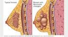 Tejido mamario normal y un seno con cambios fibroquísticos