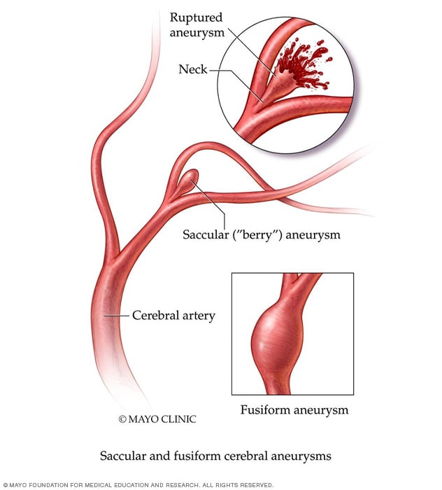 تمدد الأوعية الدموية الدماغية الكيسية والمغزلية