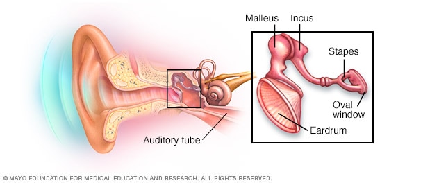 Audífonos: cómo elegir el adecuado - Mayo Clinic