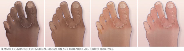 Athlete's foot (Tinea pedis): Prevention and Treatment