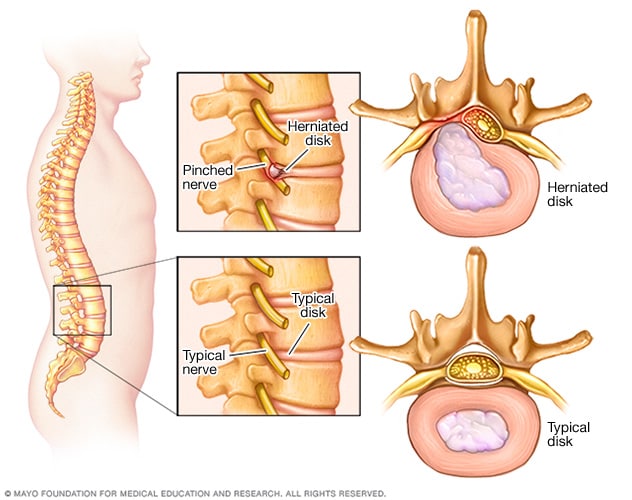 Consumer Health: Treating spinal stenosis - Mayo Clinic News Network
