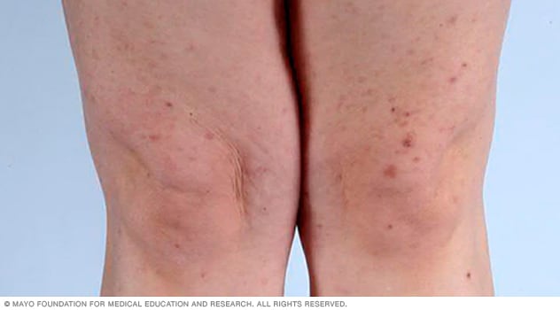 Vista de cerca de dermatitis seborreica: MedlinePlus enciclopedia médica  illustración