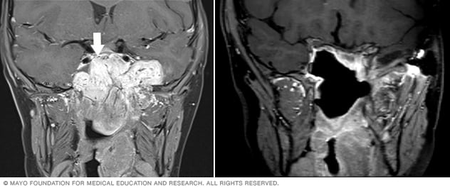 Two facial MRI scans showing the area of a juvenile nasopharyngeal angiofibroma before and after surgery.