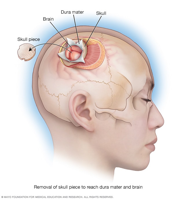 A piece of skull removed during a craniotomy.