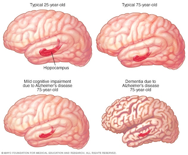 Cambios en la estructura del cerebro con el deterioro cognitivo leve y enfermedad de Alzheimer