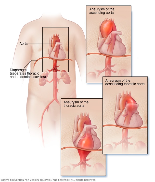 أعراض تمدد الأوعية الدموية الأبهري الصدري وأسباب Mayo Clinic