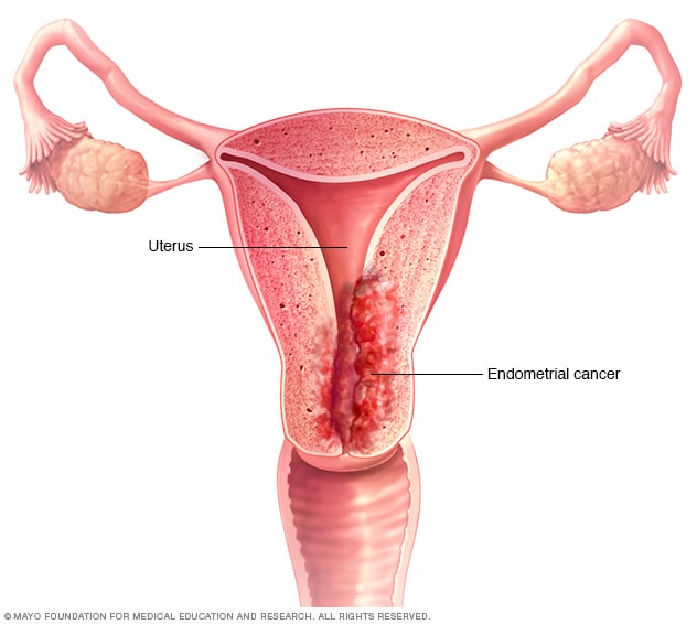 سرطان بطانة الرحم الأعراض والأسباب mayo clinic مايو كلينك