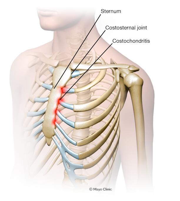 Pulled Muscle in Chest - Causes & Best Treatment Options in 2024