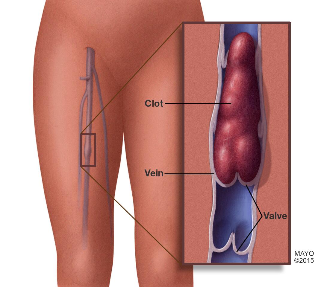 Deep vein thrombosis (DVT) - Symptoms & causes - Mayo Clinic