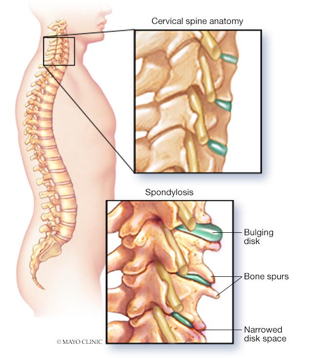 Cervical spondylosis - Symptoms & causes - Mayo Clinic