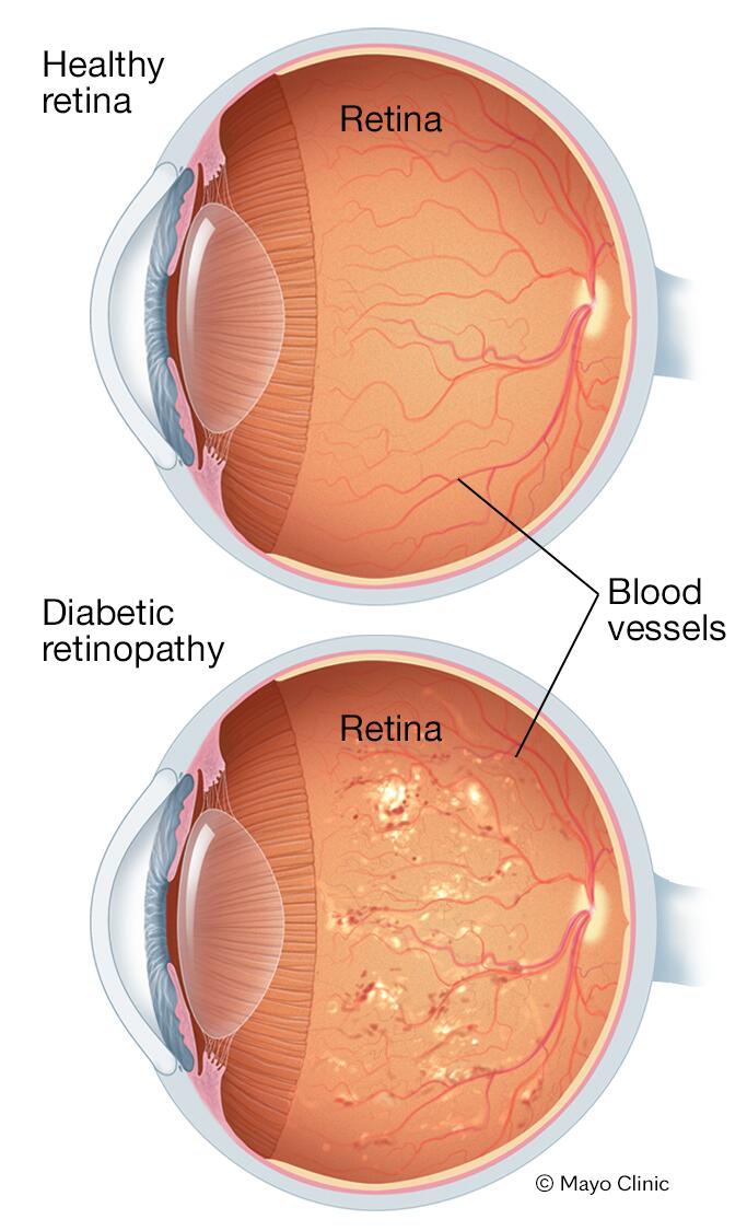 Diabetic retinopathy causes