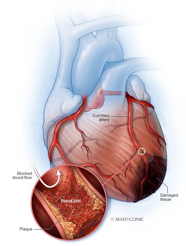 Heart Blockage: Explained with Pictures • MyHeart