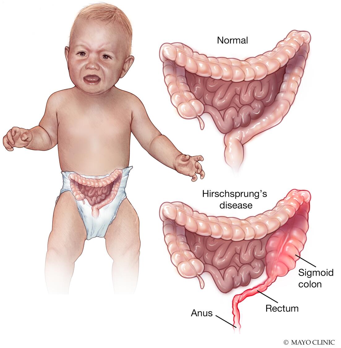 Hirschsprung&rsquo;s disease - Symptoms &amp; causes - Mayo Clinic