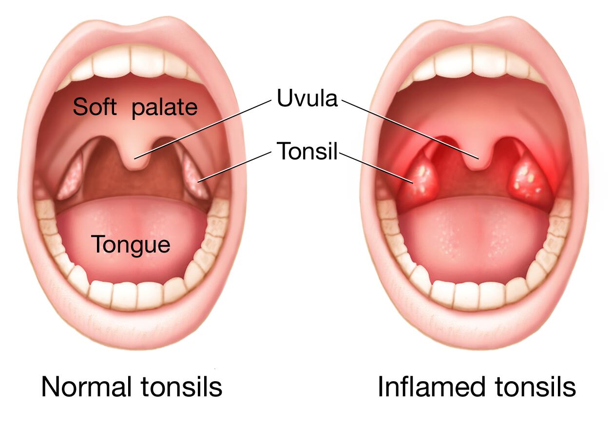 Tonsillitis - Symptoms & causes - Mayo Clinic