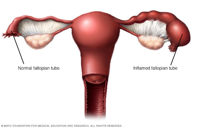 Pain in right ovary then gush of discharge — The Bump