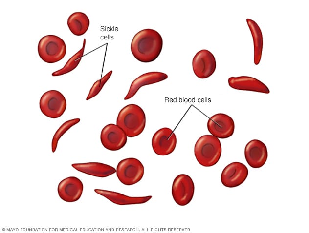 sickle cell symptoms and complications