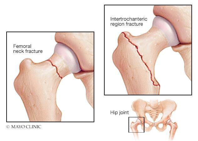 femur fracture anatomy