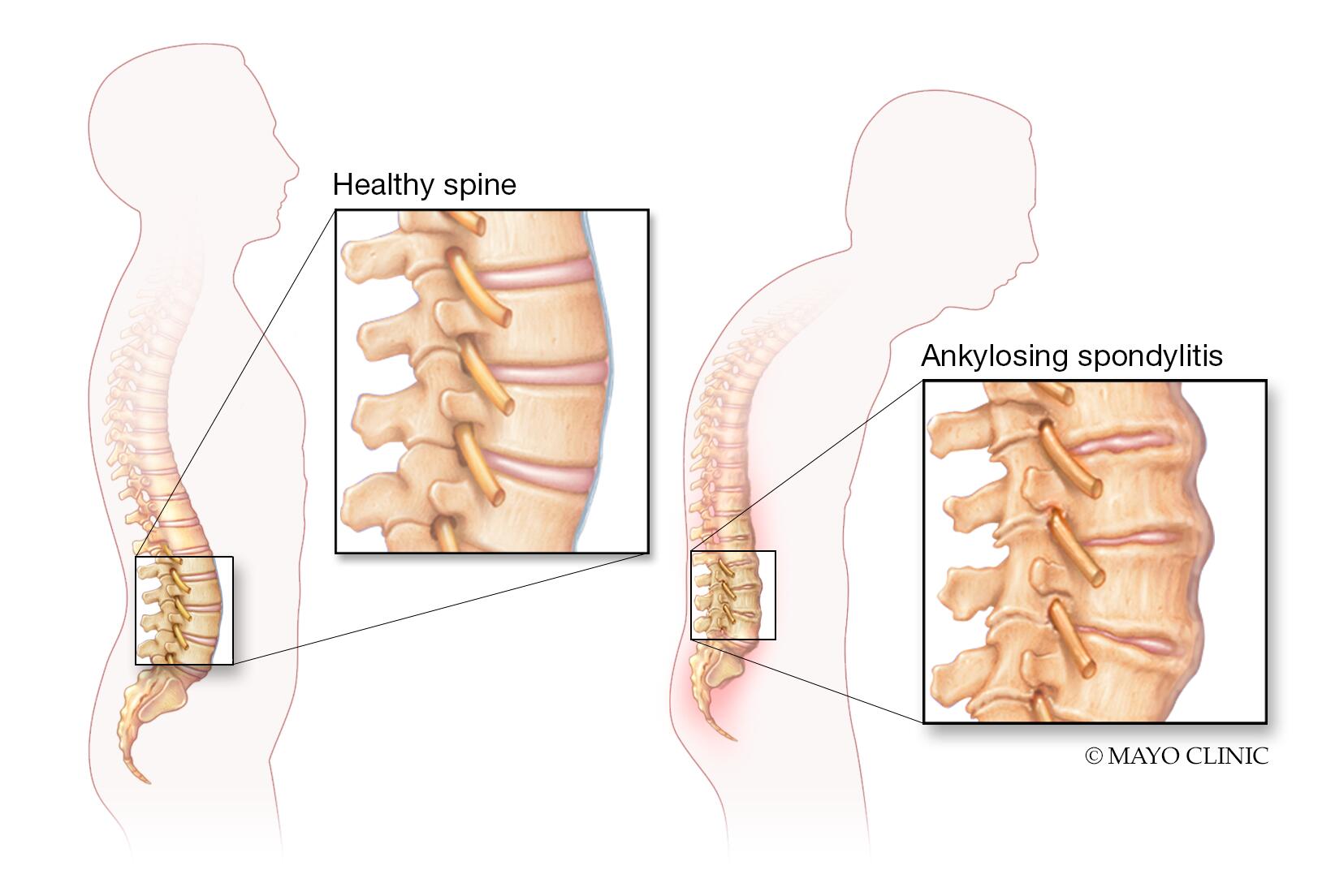  Understanding Low Back Pain Anatomical Chart