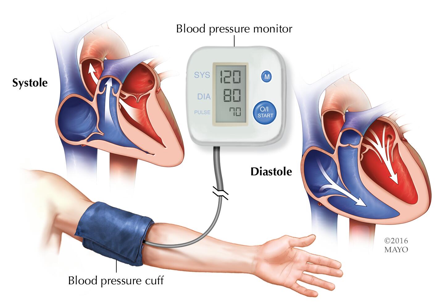 High blood pressure (hypertension) - Diagnosis & treatment - Mayo
