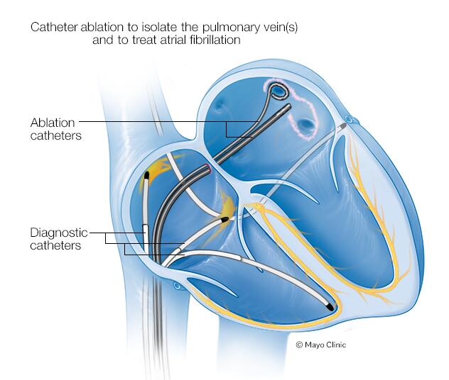 High blood pressure (hypertension) - Diagnosis & treatment - Mayo Clinic